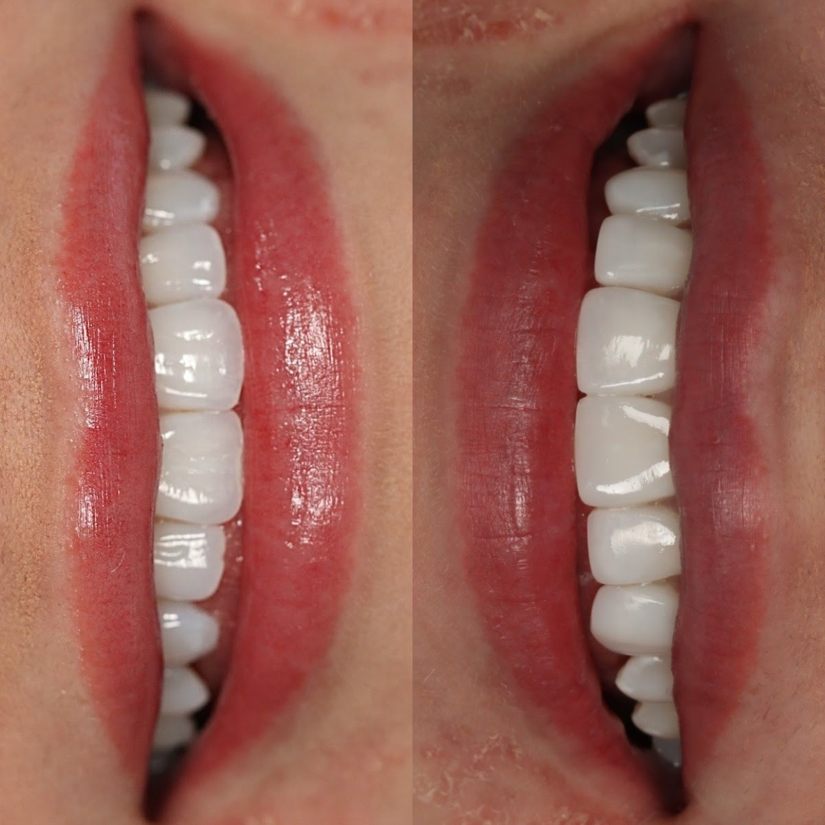 Patient before and after smile treatment at Oralia Dental