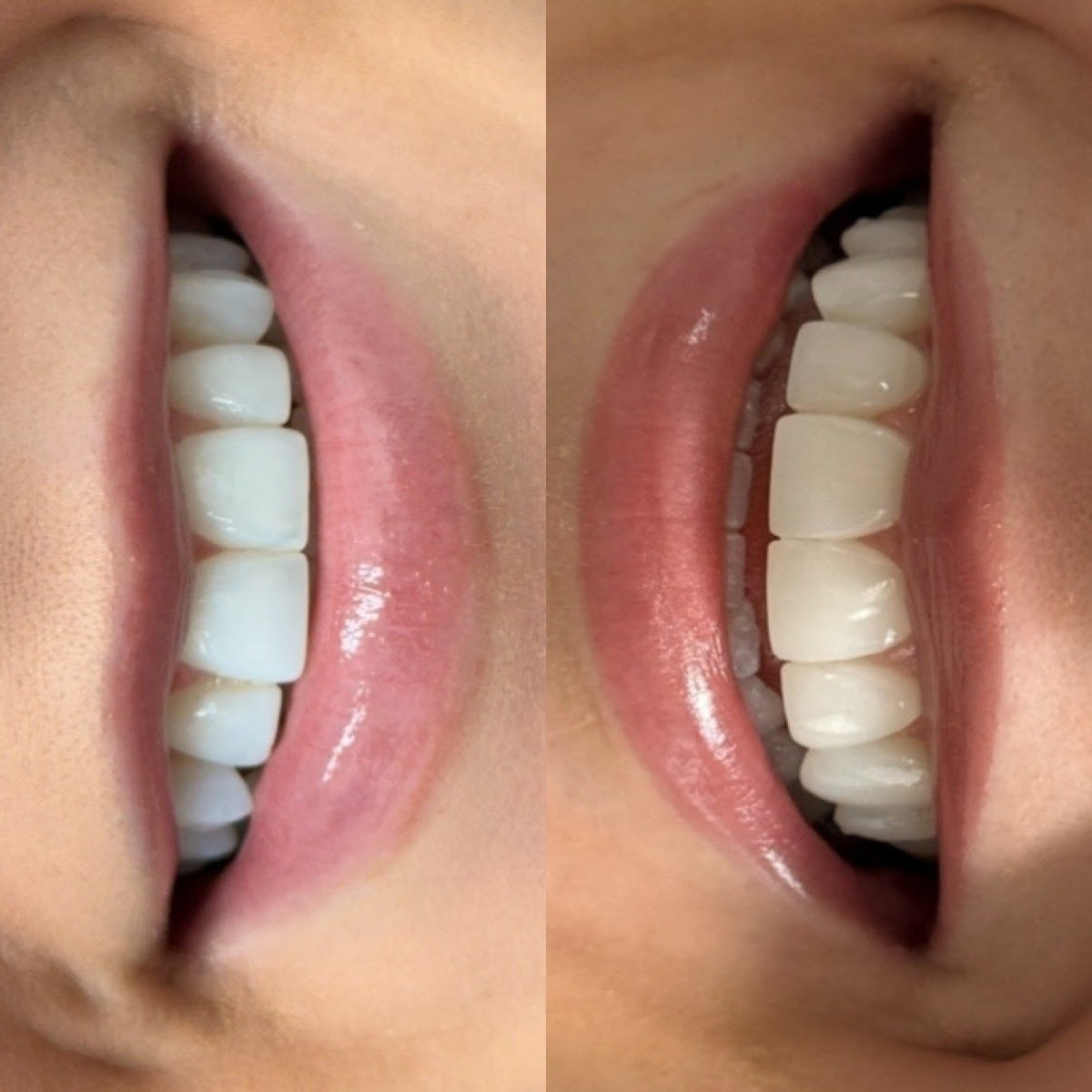 Patient before and after smile enhancement at Oralia Dental