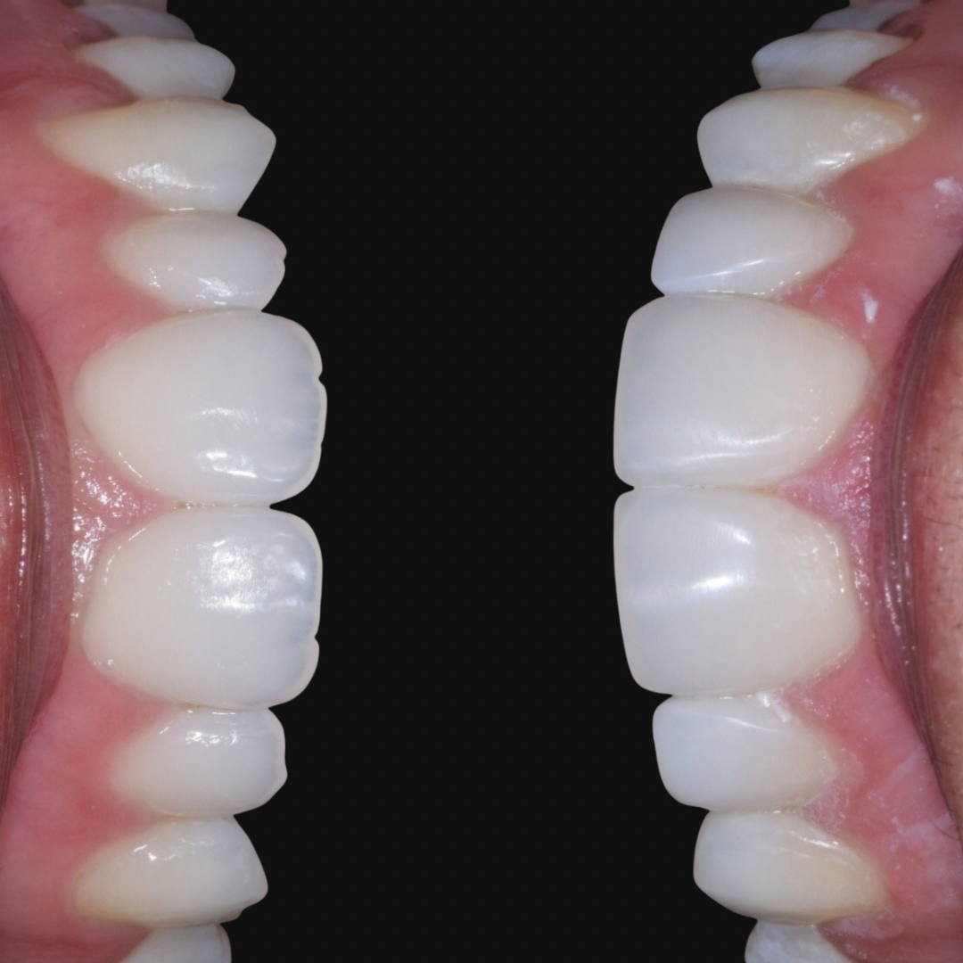 Patient before and after cosmetic dental treatment at Oralia Dental