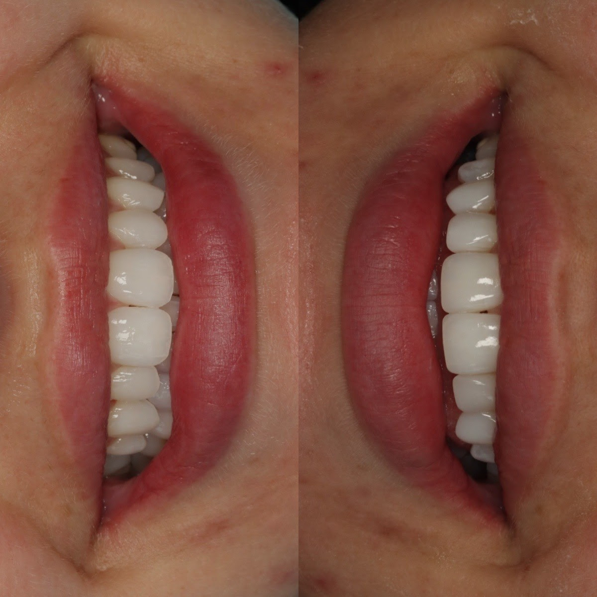 Patient before and after cosmetic dentistry at Oralia Dental